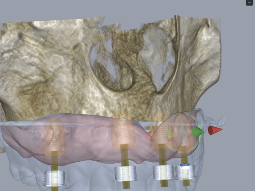 Quatro implantes posicionados na maxila, com as anilhas alinhadas sobre a prótese.