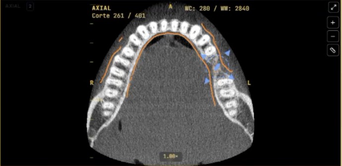 Corte axial da arcada com o contorno do escaneamento sobre os dentes da tomografia.