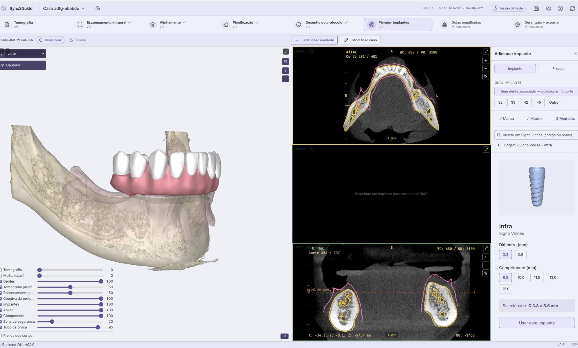 Tela Planejar implantes com a mandíbula em 3D, os cortes tomográficos e o painel de escolha do implante.