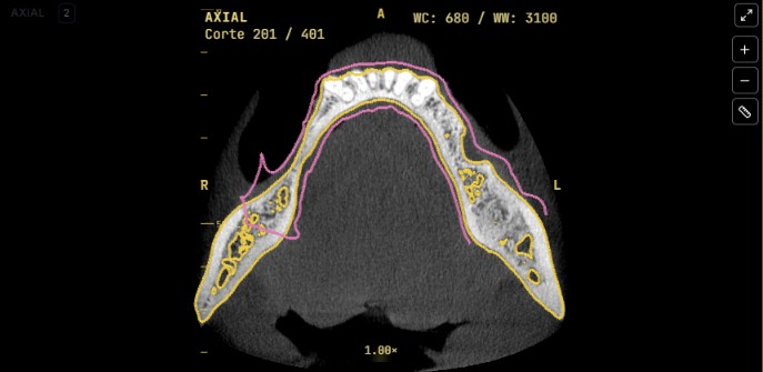 Corte axial da mandíbula na tomografia, com contornos sobrepostos.