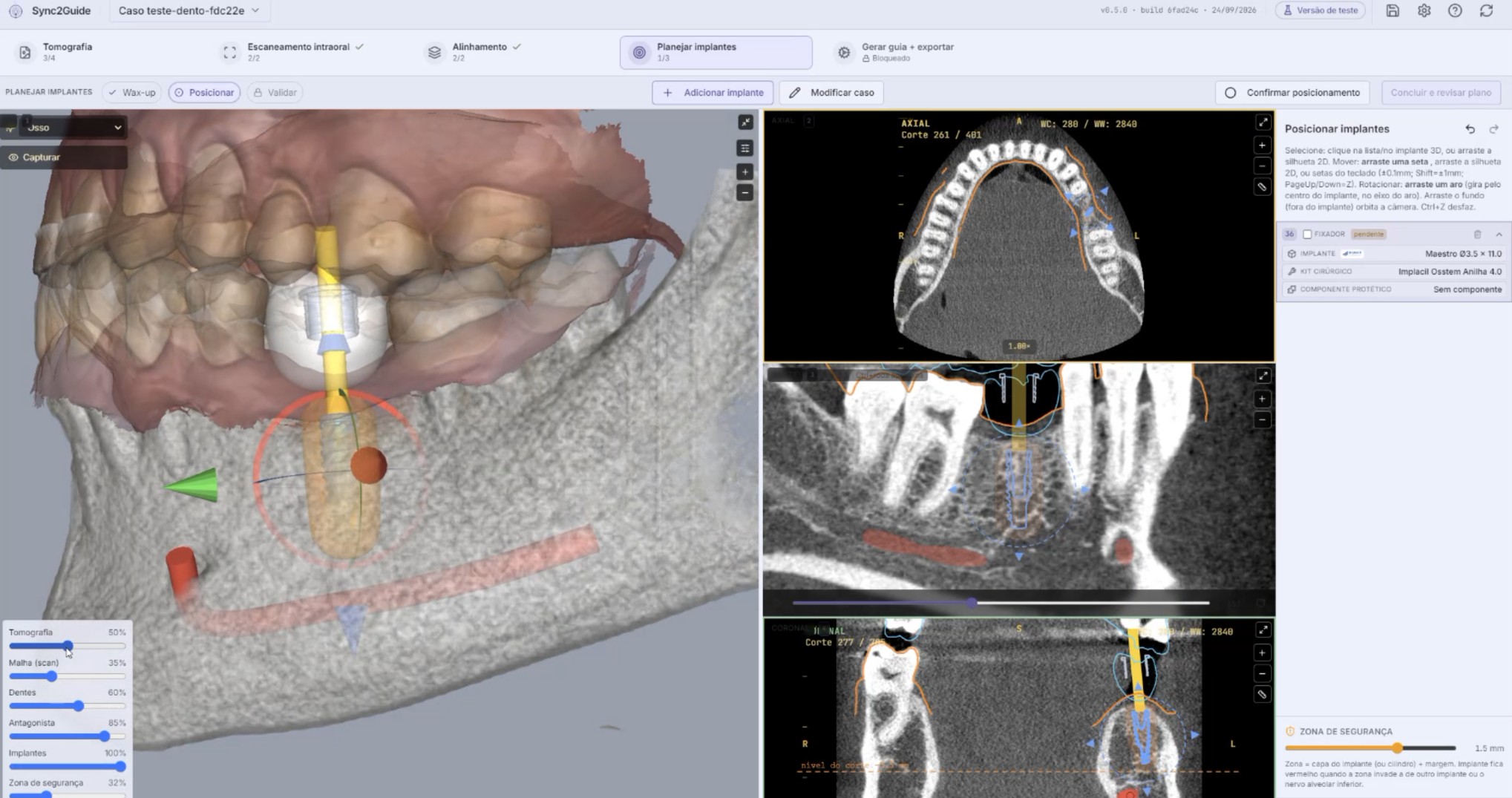 Tela do Sync2Guide na etapa Planejar implantes: implante posicionado no 3D e nos cortes tomográficos, com o canal mandibular marcado.